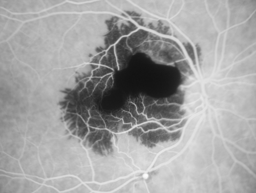 Ruptured Retinal Arterial Macroaneurysm - Submacular Hemorrhage - Vision 20/400 never recovered - Hypertension 205/94
