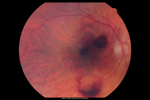 Ruptured Retinal Arterial Macroaneurysm - Submacular Hemorrhage - Vision 20/400 never recovered - Hypertension 205/94
