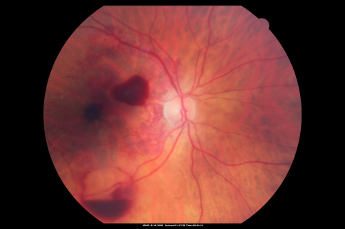 Ruptured Retinal Arterial Macroaneurysm - Submacular Hemorrhage - Vision 20/400 never recovered - Hypertension 205/94
