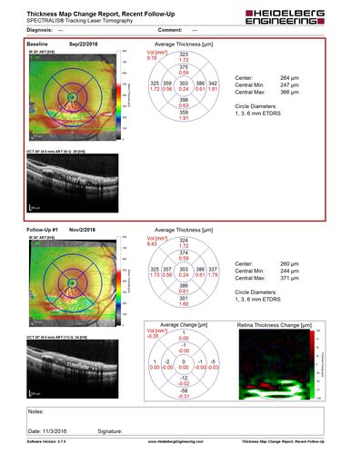 Coats' Disease - 14 year old - Asymptomatic
Presented with macular exudates.  Temporal macroaneurysms responded to laser.  Ultra-wide field FA shows nonperfusion
