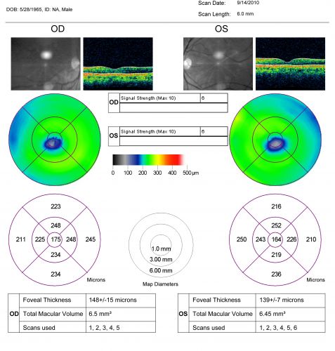Occult Maculopathy - Thin Fovea on OCT and Normal Color VA, Photos, FA VA 20/80 OU
45-year-old man his mother and his maternal grandmother each had vision loss at a relatively young age.  OCT MAP shows foveal thinning.
Schlüsselwörter: occult maculopathy;foveal atrophy