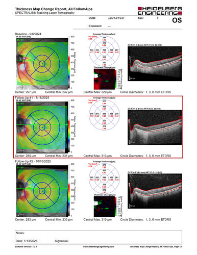 Peripapillary CNVM No Treatment
85 year old with peripapillary CNVM watched for many years.
