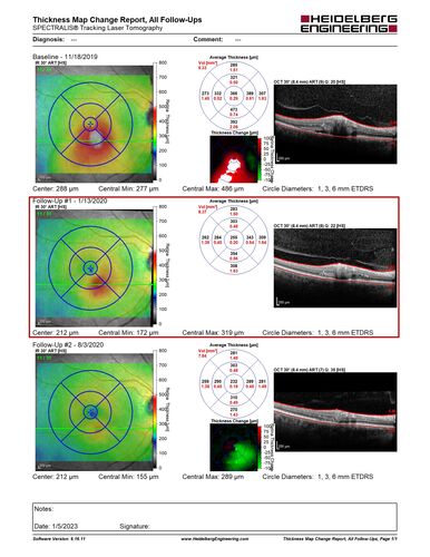 Retinal Arterial Macroaneursym
69 year old female with vision loss for a few months in the right eye.  Images show a macroaneurysm in the right eye.  The lesion had bled and FA showed no leakage.  No treatment was done.  VA improved from 20/40 - 20/32
