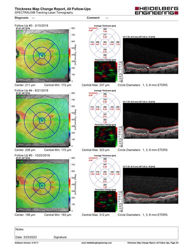 Asymptomatic wet AMD OS - never treated
Vision remains 20/20 at 6 year follow-up with no treatment
