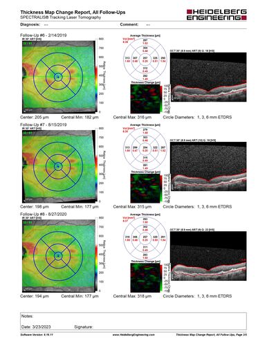 Asymptomatic wet AMD OS - never treated
Vision remains 20/20 at 6 year follow-up with no treatment
