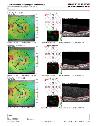 Asymptomatic wet AMD OS - never treated
Vision remains 20/20 at 6 year follow-up with no treatment
