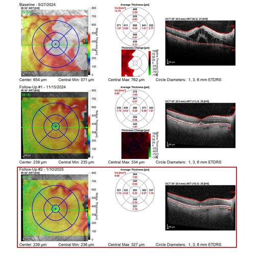 Central Retinal Vein Occlusion - Non-Ischemic - Excellent Outcome
57 year old man The right eye has had vision loss for about 3 weeks.  He woke up with vision loss. 
Medical Hx: HIV . Diabetes Mellitus (since 2014). Thyroid Disease. 
Systemic Meds: gemboya. Metformin Hydrochloride. trulicity. losartan. vesepa. Synthroid .
VA OD: sc20/160 OS: sc20/20 
TP: OD:14 OS:14
Treated with Avastin
VA 6 weeks later 20/32 – dry one shot.
Missed follow-up after second treatment and came  5 months later with good vision and no macular edema
