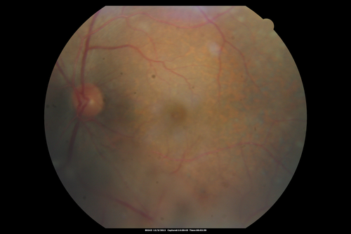 Uveitis - Retinitis - Vasculitis - possibly Syphilitis
Visit 1: 12-06-12
74-year-old man 12-3-12 visit.  2 months ago noticed vision loss, first in the right eye than the left.   He is getting tired easily.  He canâ€™t walk for a long distance.  He has lost five pounds within the last month. He also had a severe itchy episode, but not quite a rash a few days ago, which went away after he took a shower.  FTA-ABS is positive but a spinal tap, which was negative.  OD 1/200,  OS 20/63.  
