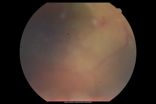Uveitis - Retinitis - Vasculitis - possibly Syphilitis
Visit 1: 12-06-12
74-year-old man 12-3-12 visit.  2 months ago noticed vision loss, first in the right eye than the left.   He is getting tired easily.  He canâ€™t walk for a long distance.  He has lost five pounds within the last month. He also had a severe itchy episode, but not quite a rash a few days ago, which went away after he took a shower.  FTA-ABS is positive but a spinal tap, which was negative.  OD 1/200,  OS 20/63.  
