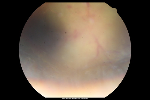 Uveitis - Retinitis - Vasculitis - possibly Syphilitis
Visit 1: 12-06-12
74-year-old man 12-3-12 visit.  2 months ago noticed vision loss, first in the right eye than the left.   He is getting tired easily.  He canâ€™t walk for a long distance.  He has lost five pounds within the last month. He also had a severe itchy episode, but not quite a rash a few days ago, which went away after he took a shower.  FTA-ABS is positive but a spinal tap, which was negative.  OD 1/200,  OS 20/63.  
