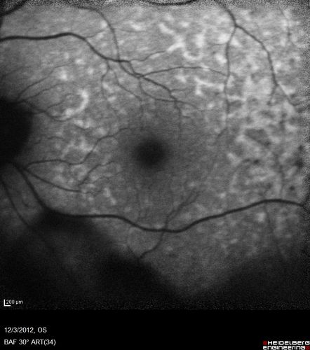 Uveitis - Retinitis - Vasculitis - possibly Syphilitis
Visit 1: 12-06-12
74-year-old man 12-3-12 visit.  2 months ago noticed vision loss, first in the right eye than the left.   He is getting tired easily.  He canâ€™t walk for a long distance.  He has lost five pounds within the last month. He also had a severe itchy episode, but not quite a rash a few days ago, which went away after he took a shower.  FTA-ABS is positive but a spinal tap, which was negative.  OD 1/200,  OS 20/63.  
