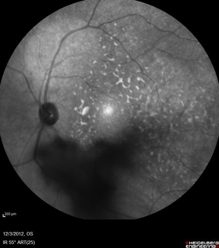 Uveitis - Retinitis - Vasculitis - possibly Syphilitis
Visit 1: 12-06-12
74-year-old man 12-3-12 visit.  2 months ago noticed vision loss, first in the right eye than the left.   He is getting tired easily.  He canâ€™t walk for a long distance.  He has lost five pounds within the last month. He also had a severe itchy episode, but not quite a rash a few days ago, which went away after he took a shower.  FTA-ABS is positive but a spinal tap, which was negative.  OD 1/200,  OS 20/63.  
