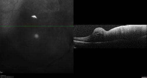 Uveitis - Retinitis - Vasculitis - possibly Syphilitis
Visit 1: 12-06-12
74-year-old man 12-3-12 visit.  2 months ago noticed vision loss, first in the right eye than the left.   He is getting tired easily.  He canâ€™t walk for a long distance.  He has lost five pounds within the last month. He also had a severe itchy episode, but not quite a rash a few days ago, which went away after he took a shower.  FTA-ABS is positive but a spinal tap, which was negative.  OD 1/200,  OS 20/63.  

