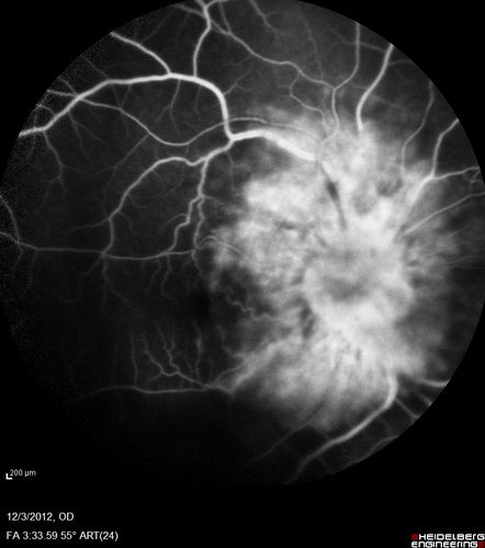 Uveitis - Retinitis - Vasculitis - possibly Syphilitis
Visit 1: 12-06-12
74-year-old man 12-3-12 visit.  2 months ago noticed vision loss, first in the right eye than the left.   He is getting tired easily.  He canâ€™t walk for a long distance.  He has lost five pounds within the last month. He also had a severe itchy episode, but not quite a rash a few days ago, which went away after he took a shower.  FTA-ABS is positive but a spinal tap, which was negative.  OD 1/200,  OS 20/63.  
