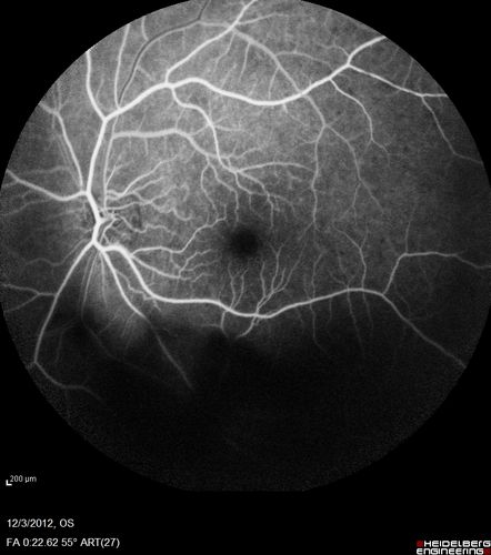 Uveitis - Retinitis - Vasculitis - possibly Syphilitis
Visit 1: 12-06-12
74-year-old man 12-3-12 visit.  2 months ago noticed vision loss, first in the right eye than the left.   He is getting tired easily.  He canâ€™t walk for a long distance.  He has lost five pounds within the last month. He also had a severe itchy episode, but not quite a rash a few days ago, which went away after he took a shower.  FTA-ABS is positive but a spinal tap, which was negative.  OD 1/200,  OS 20/63.  
