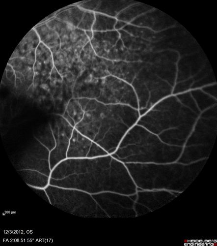 Uveitis - Retinitis - Vasculitis - possibly Syphilitis
Visit 1: 12-06-12
74-year-old man 12-3-12 visit.  2 months ago noticed vision loss, first in the right eye than the left.   He is getting tired easily.  He canâ€™t walk for a long distance.  He has lost five pounds within the last month. He also had a severe itchy episode, but not quite a rash a few days ago, which went away after he took a shower.  FTA-ABS is positive but a spinal tap, which was negative.  OD 1/200,  OS 20/63.  
