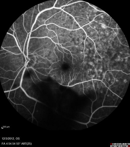 Uveitis - Retinitis - Vasculitis - possibly Syphilitis
Visit 1: 12-06-12
74-year-old man 12-3-12 visit.  2 months ago noticed vision loss, first in the right eye than the left.   He is getting tired easily.  He canâ€™t walk for a long distance.  He has lost five pounds within the last month. He also had a severe itchy episode, but not quite a rash a few days ago, which went away after he took a shower.  FTA-ABS is positive but a spinal tap, which was negative.  OD 1/200,  OS 20/63.  
