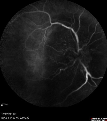 Uveitis - Retinitis - Vasculitis - possibly Syphilitis
Visit 1: 12-06-12
74-year-old man 12-3-12 visit.  2 months ago noticed vision loss, first in the right eye than the left.   He is getting tired easily.  He canâ€™t walk for a long distance.  He has lost five pounds within the last month. He also had a severe itchy episode, but not quite a rash a few days ago, which went away after he took a shower.  FTA-ABS is positive but a spinal tap, which was negative.  OD 1/200,  OS 20/63.  
