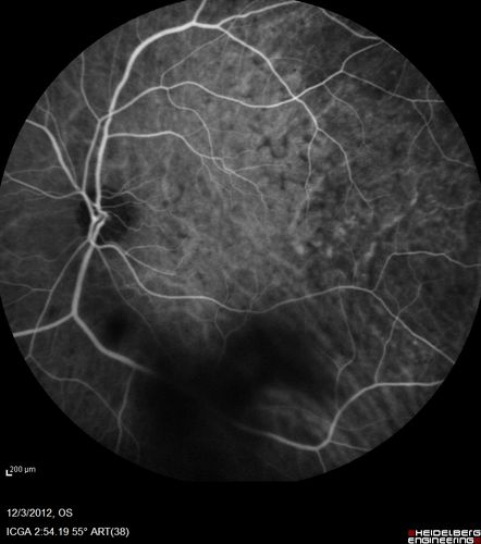 Uveitis - Retinitis - Vasculitis - possibly Syphilitis
Visit 1: 12-06-12
74-year-old man 12-3-12 visit.  2 months ago noticed vision loss, first in the right eye than the left.   He is getting tired easily.  He canâ€™t walk for a long distance.  He has lost five pounds within the last month. He also had a severe itchy episode, but not quite a rash a few days ago, which went away after he took a shower.  FTA-ABS is positive but a spinal tap, which was negative.  OD 1/200,  OS 20/63.  
