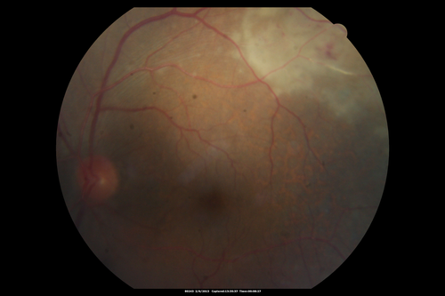 Vasculitis - Retinitis - Uveitis - Vision NLP right eye , 20/50 left eye
