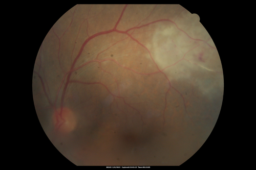 Vasculitis - Retinitis - Uveitis - Vision NLP right eye , 20/50 left eye
