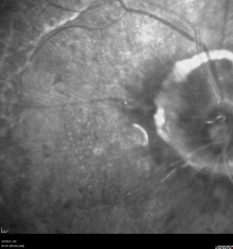 Vasculitis - Retinitis - Uveitis - Vision NLP right eye , 20/50 left eye
