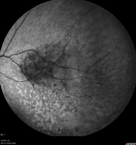 Vasculitis - Retinitis - Uveitis - Vision NLP right eye , 20/50 left eye
