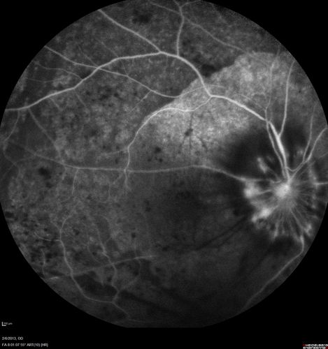 Vasculitis - Retinitis - Uveitis - Vision NLP right eye , 20/50 left eye
