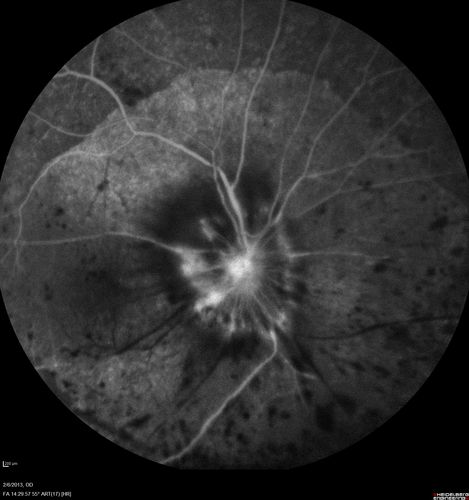 Vasculitis - Retinitis - Uveitis - Vision NLP right eye , 20/50 left eye
