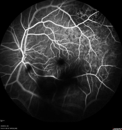 Vasculitis - Retinitis - Uveitis - Vision NLP right eye , 20/50 left eye
