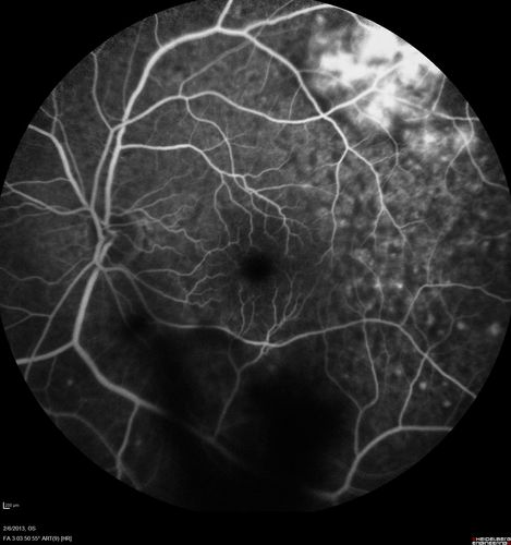 Vasculitis - Retinitis - Uveitis - Vision NLP right eye , 20/50 left eye
