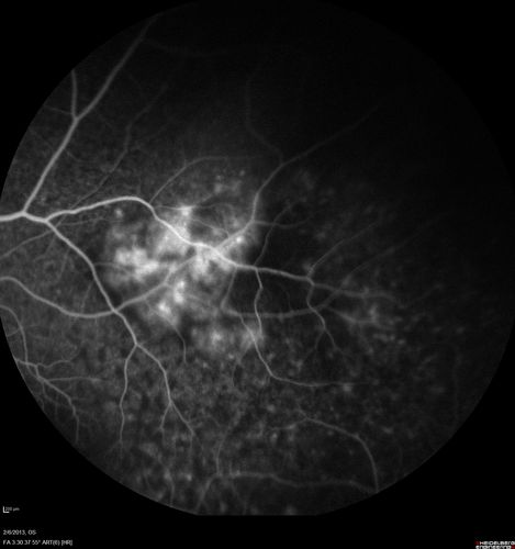 Vasculitis - Retinitis - Uveitis - Vision NLP right eye , 20/50 left eye
