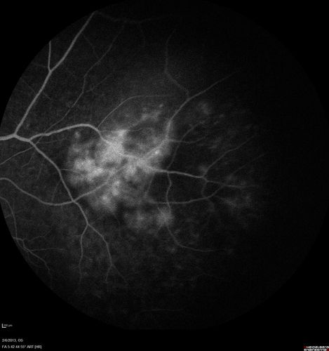 Vasculitis - Retinitis - Uveitis - Vision NLP right eye , 20/50 left eye
