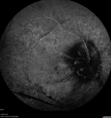 Vasculitis - Retinitis - Uveitis - Vision NLP right eye , 20/50 left eye
