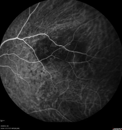 Vasculitis - Retinitis - Uveitis - Vision NLP right eye , 20/50 left eye
