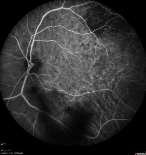 Vasculitis - Retinitis - Uveitis - Vision NLP right eye , 20/50 left eye
