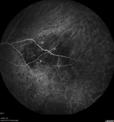 Vasculitis - Retinitis - Uveitis - Vision NLP right eye , 20/50 left eye
