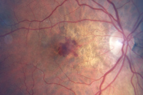 Wet AMD - New Small Hemorrhage Both Eyes - Mature CNVM visible on Early Indocyanine Green Angiogram
