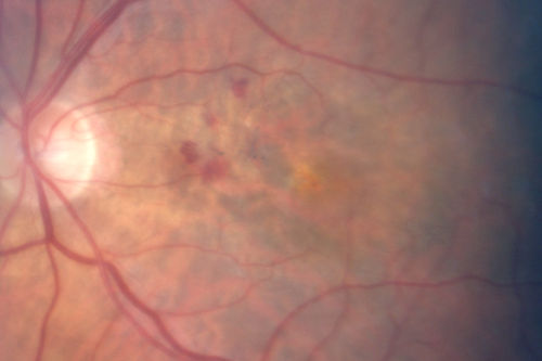 Wet AMD - New Small Hemorrhage Both Eyes - Mature CNVM visible on Early Indocyanine Green Angiogram
