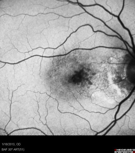 Wet AMD - New Small Hemorrhage Both Eyes - Mature CNVM visible on Early Indocyanine Green Angiogram
