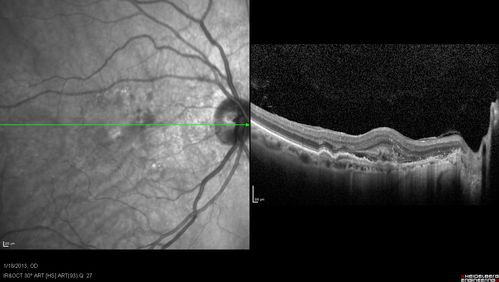 Wet AMD - New Small Hemorrhage Both Eyes - Mature CNVM visible on Early Indocyanine Green Angiogram
