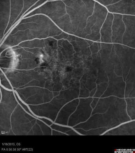 Wet AMD - New Small Hemorrhage Both Eyes - Mature CNVM visible on Early Indocyanine Green Angiogram
