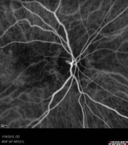 Wet AMD - New Small Hemorrhage Both Eyes - Mature CNVM visible on Early Indocyanine Green Angiogram
