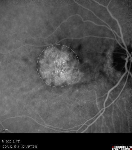 Wet AMD - New Small Hemorrhage Both Eyes - Mature CNVM visible on Early Indocyanine Green Angiogram

