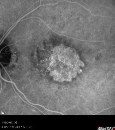 Wet AMD - New Small Hemorrhage Both Eyes - Mature CNVM visible on Early Indocyanine Green Angiogram
