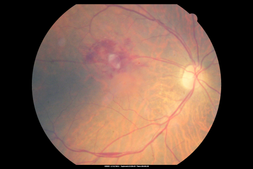 Retinal Arterial Macroaneurysm - Increased Swelling after Laser 
65-year-old woman was seen in the office on January 12, 2011.   She has noticed decreased vision in the right eye for the last two or three weeks.  She has had some discomfort in both eyes as well.  She has a history of low blood pressure, but she does have high cholesterol.  

VISUAL ACUITY:  OD 20/60
