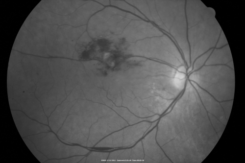 Retinal Arterial Macroaneurysm - Increased Swelling after Laser 
65-year-old woman was seen in the office on January 12, 2011.   She has noticed decreased vision in the right eye for the last two or three weeks.  She has had some discomfort in both eyes as well.  She has a history of low blood pressure, but she does have high cholesterol.  

VISUAL ACUITY:  OD 20/60
