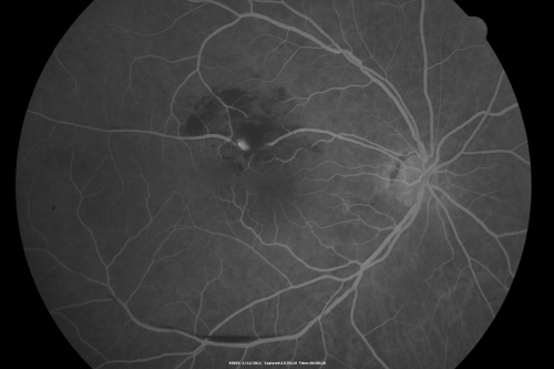Retinal Arterial Macroaneurysm - Increased Swelling after Laser 
65-year-old woman was seen in the office on January 12, 2011.   She has noticed decreased vision in the right eye for the last two or three weeks.  She has had some discomfort in both eyes as well.  She has a history of low blood pressure, but she does have high cholesterol.  

VISUAL ACUITY:  OD 20/60
