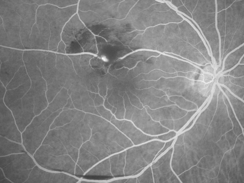 Retinal Arterial Macroaneurysm - Increased Swelling after Laser 
65-year-old woman was seen in the office on January 12, 2011.   She has noticed decreased vision in the right eye for the last two or three weeks.  She has had some discomfort in both eyes as well.  She has a history of low blood pressure, but she does have high cholesterol.  

VISUAL ACUITY:  OD 20/60
