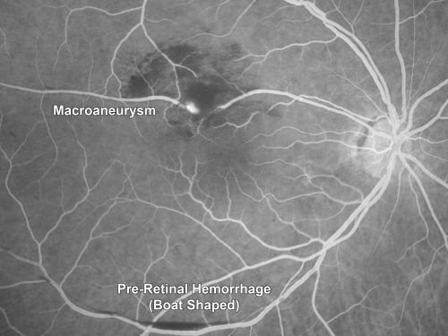 Retinal Arterial Macroaneurysm - Increased Swelling after Laser 
65-year-old woman was seen in the office on January 12, 2011.   She has noticed decreased vision in the right eye for the last two or three weeks.  She has had some discomfort in both eyes as well.  She has a history of low blood pressure, but she does have high cholesterol.  

VISUAL ACUITY:  OD 20/60
